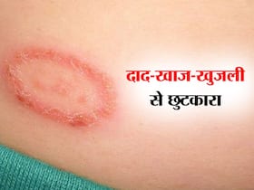 गर्मियों में दाद-खाज-खुजली से हैं परेशान तो ये 5 उपाय दिलाएंगे आराम  