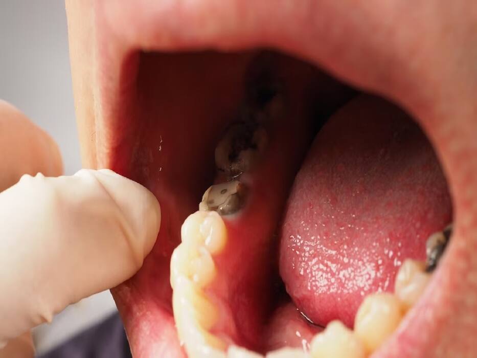 4 Most Common Oral Diseases: Causes And Prevention