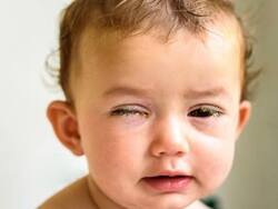 New Symptoms of COVID-19 In Children: Sticky Eyes And 4 Top Signs To Look Out For