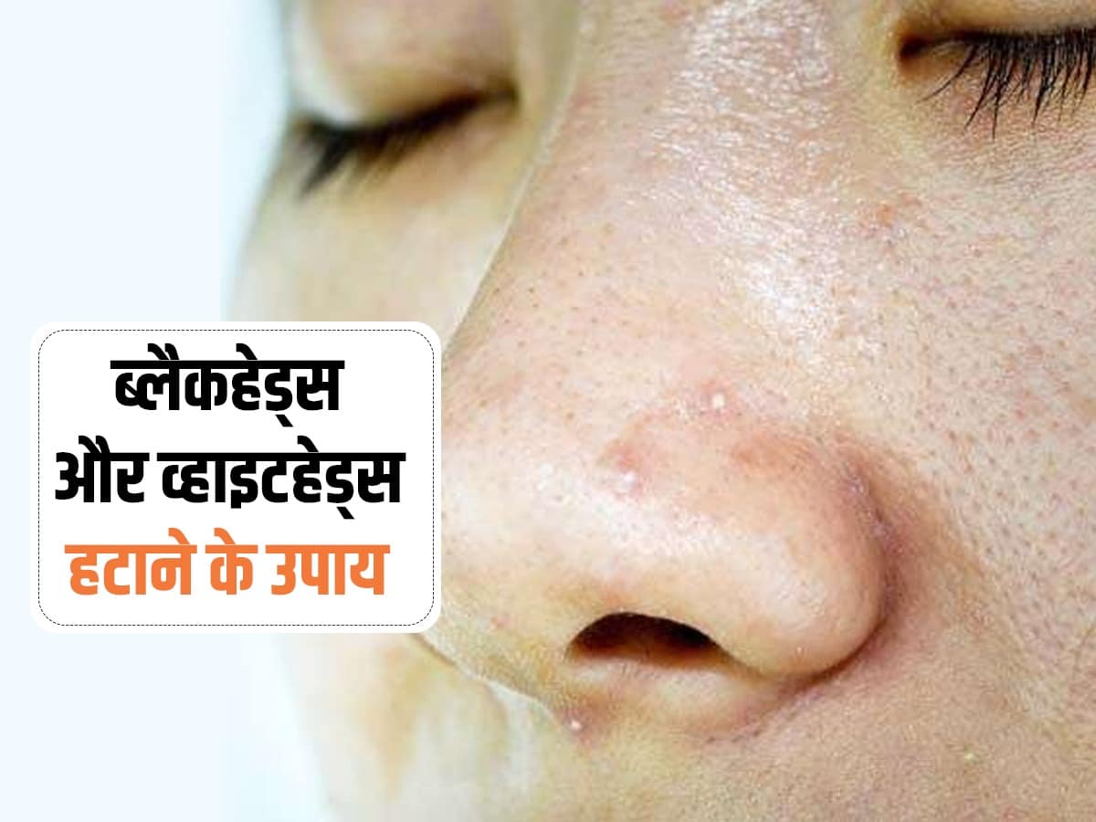 Blackheads and Whiteheads Remover गर्मियों में बढ़ जाती है ब्लैकहेड्स