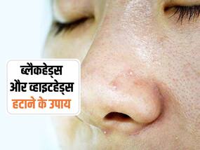 गर्मियों में बढ़ जाती है ब्लैकहेड्स और व्हाइटहेड्स की परेशानी, इस 3 असरदार उपायों से करें इलाज