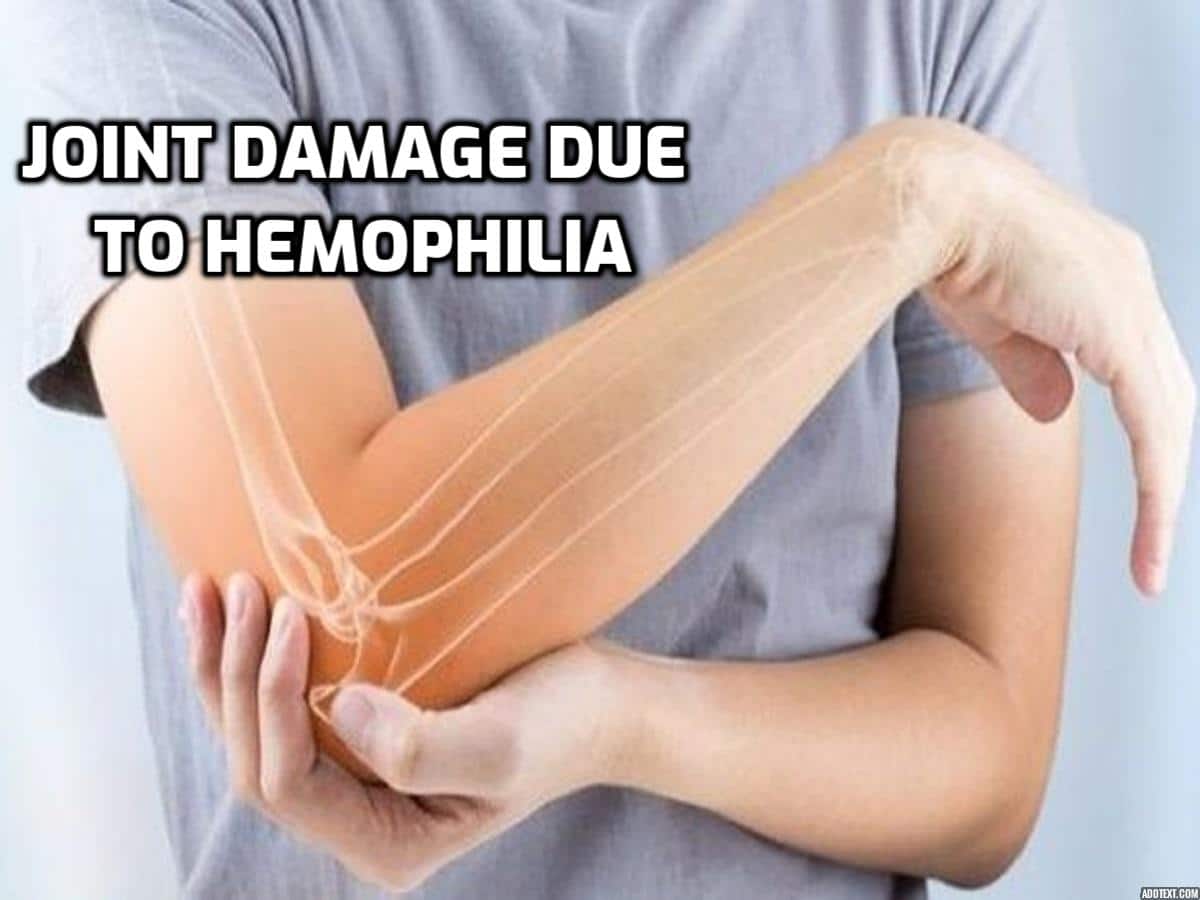 Joint Damage in Severe Hemophilia A: The Importance of Early Treatment - Vimarsana News