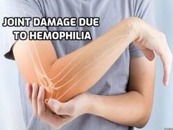 Joint Damage in Severe Hemophilia A: The Importance of Early Treatment