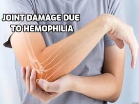 Joint Damage in Severe Hemophilia A: The Importance of Early Treatment