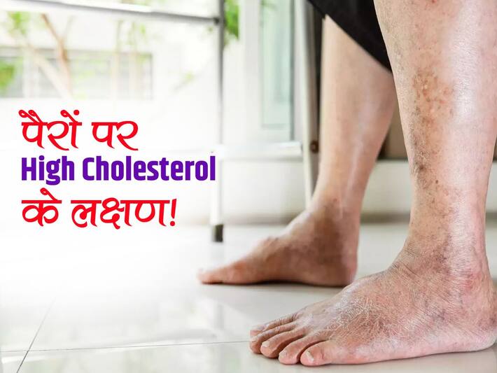 High Cholesterol signs on legs in hindi कोलेस्ट्रॉल बढ़ने पर महीने भर