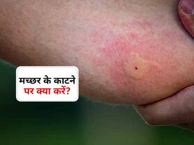 मलेरिया का मच्छर छू नहीं पाएगा करेंगे डॉक्टर के बताए ये 3 काम! जानें मच्छर के काटने पर पहला काम कौन सा जरूरी
