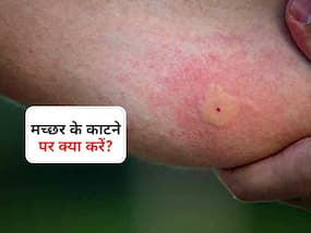 मलेरिया का मच्छर छू नहीं पाएगा करेंगे डॉक्टर के बताए ये 3 काम! जानें मच्छर के काटने पर पहला काम कौन सा जरूरी