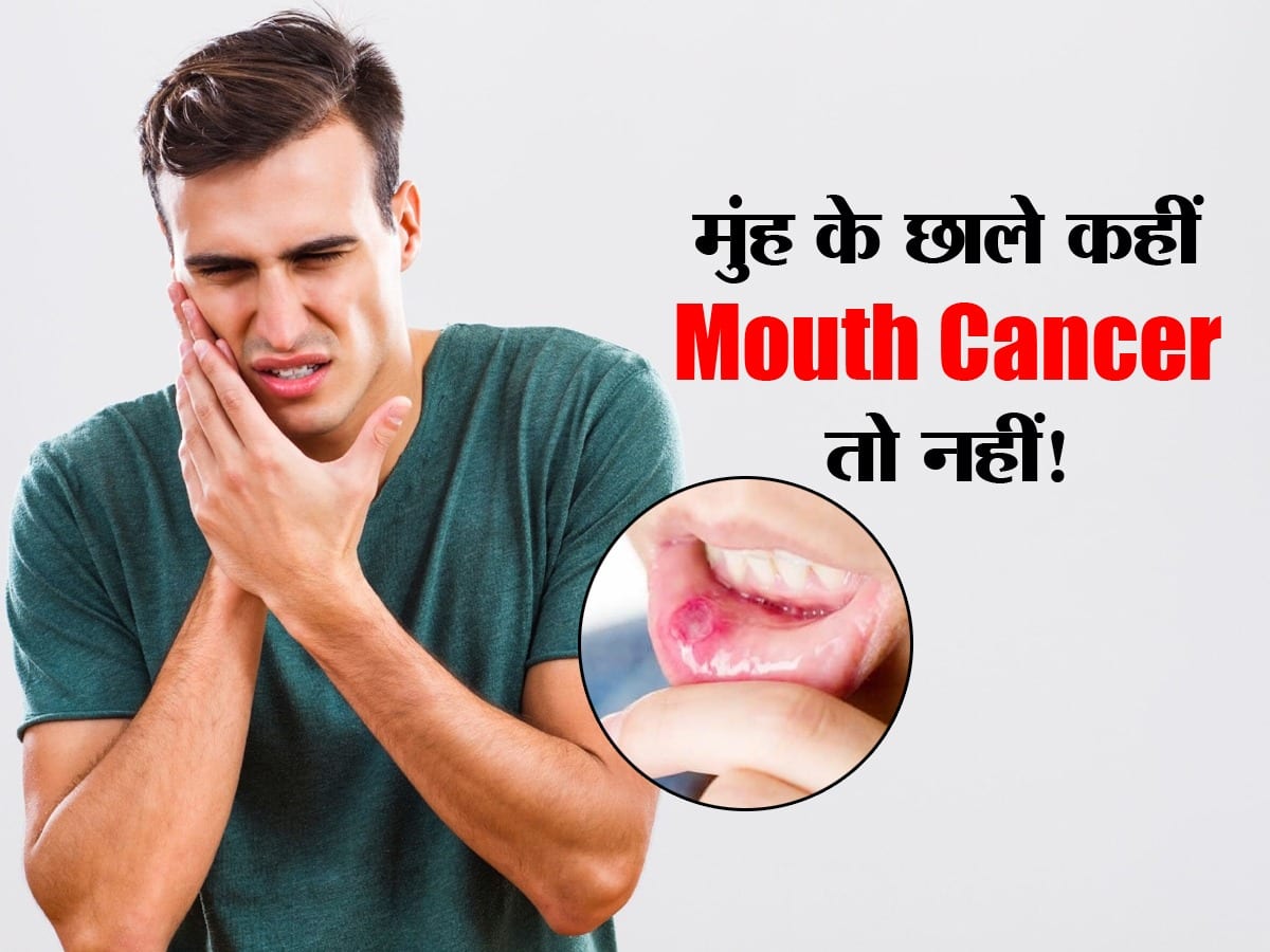 mouth-cancer