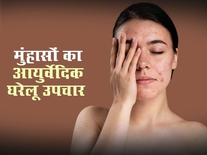 Muhase Ka Ayurvedic Ilaj कीलमुंहासे हमेशा के लिए खत्म कर देंगे ये 5