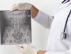 Ankylosing Spondylitis: 5 Things To Understand