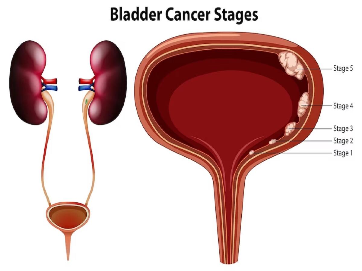 Do You Know Tobacco Consumption Is Responsible For 40-60% Of Bladder ...