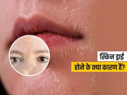ड्राई स्किन के 5 कारण, जानिए रूखी त्वचा के लिए घर में मॉइस्चराइजिंग क्रीम बनाने का तरीका