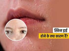 ड्राई स्किन के 5 कारण, जानिए रूखी त्वचा के लिए घर में मॉइस्चराइजिंग क्रीम बनाने का तरीका