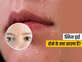 ड्राई स्किन के 5 कारण, जानिए रूखी त्वचा के लिए घर में मॉइस्चराइजिंग क्रीम बनाने का तरीका