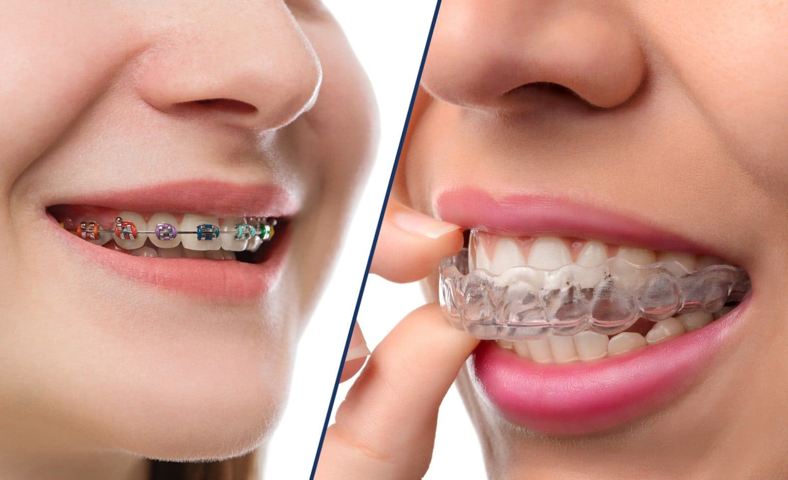 What Are Clear Braces? The Pros and Cons of Invisible Aligners