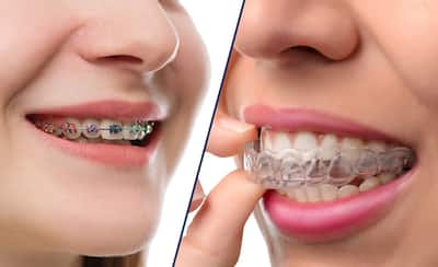 What are explicit braces?  Pros and Cons of Invisible Aligners
