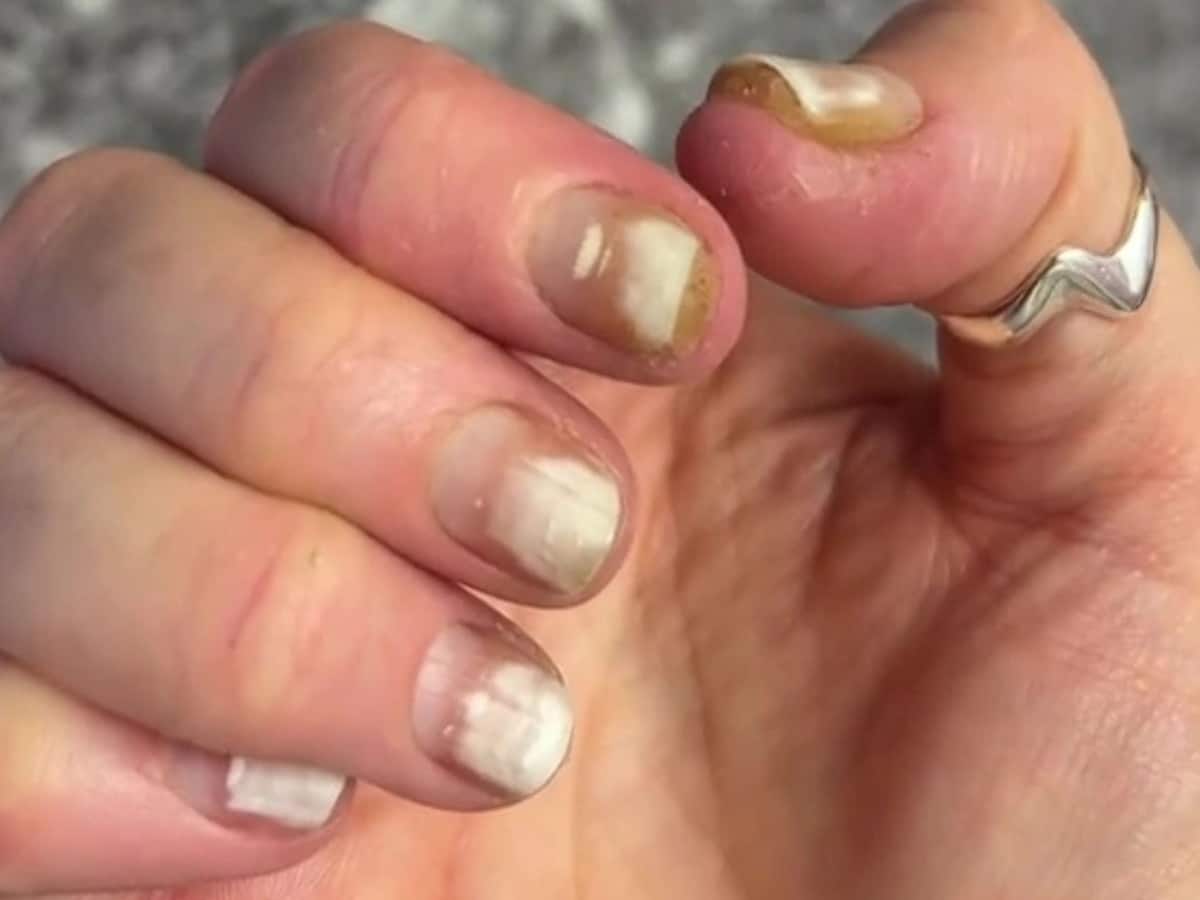 Is the Black Line on Your Nail Normal or Melanoma How To tell