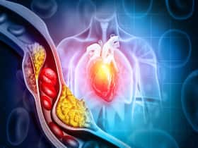 Diagnosed With High Cholesterol? 7 Things To Keep In Mind