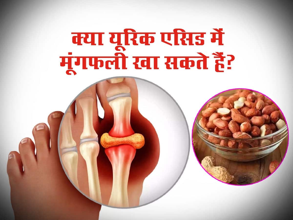 Can We Eat Peanut in High Uric Acid क्या यूरिक एसिड में मूंगफली खा