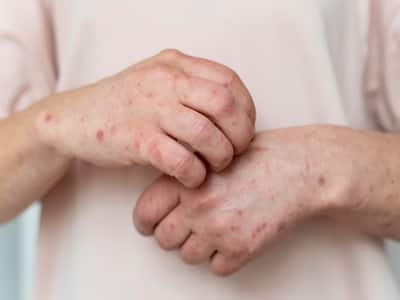 Homeopathic Remedies For Skin Rashes