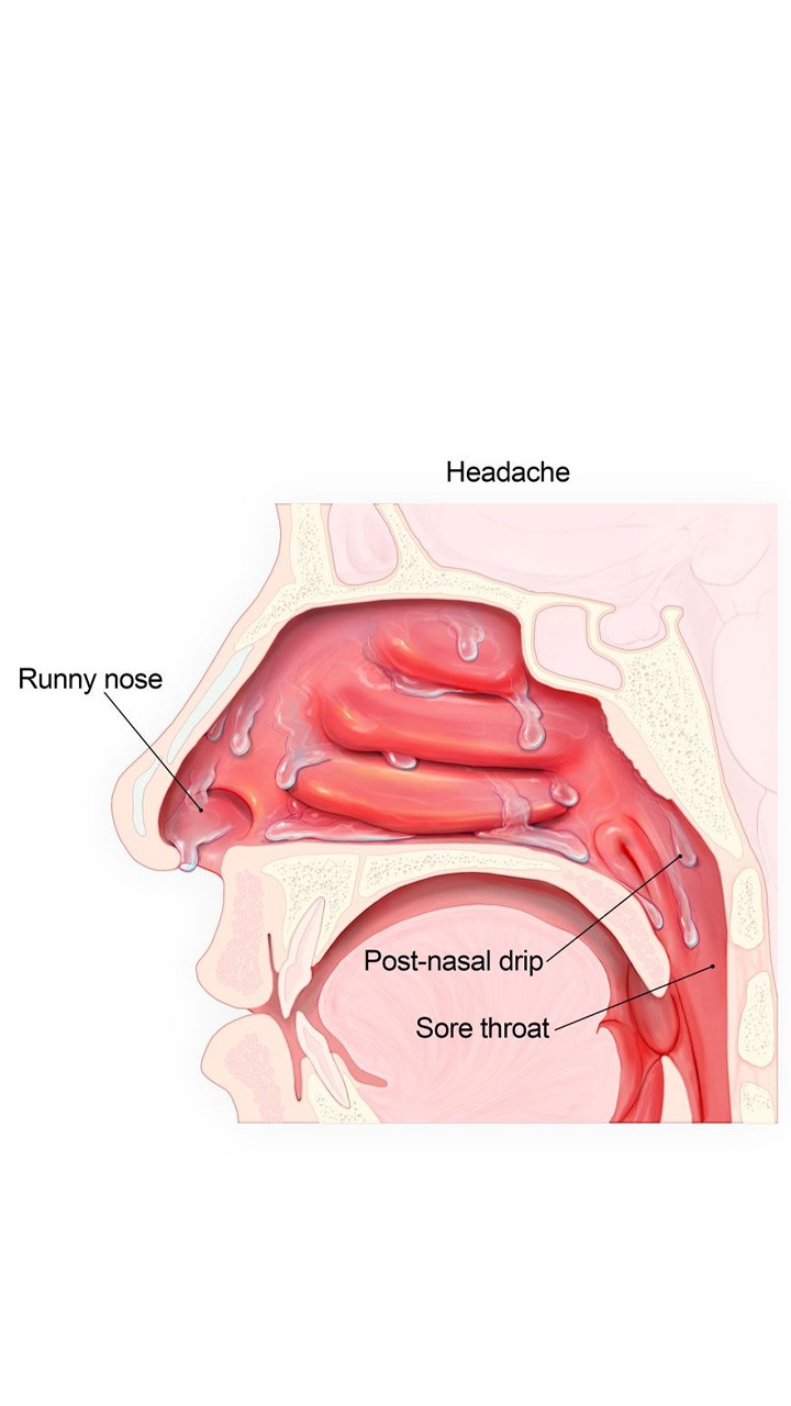 Mucus In Throat And Nose: 5 Foods To Eat And Avoid