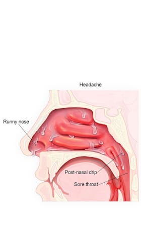 Mucus In Throat And Nose: 5 Foods To Eat And Avoid