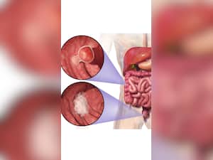 Why Is Colon Cancer A Leading Cause Of Cancer Deaths?