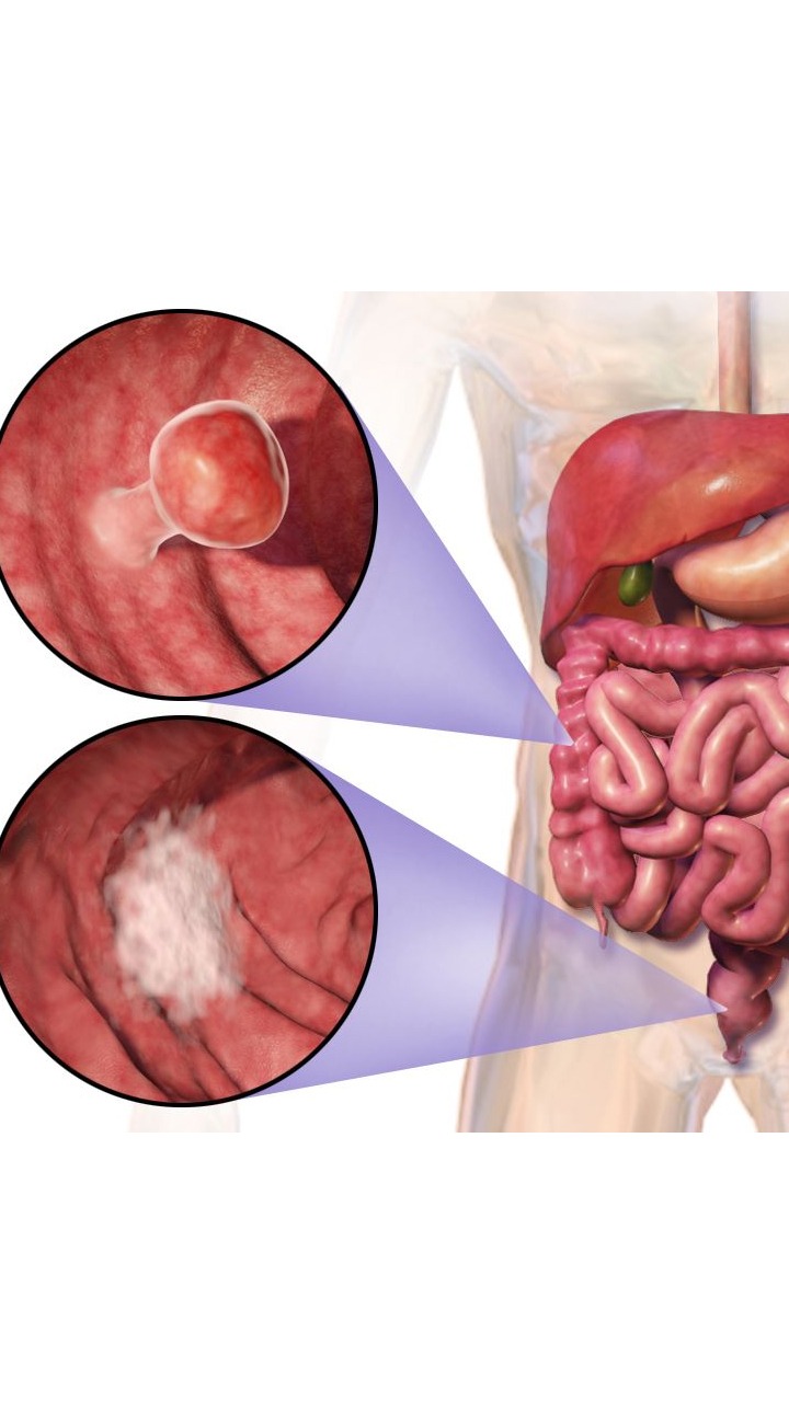 Why Is Colon Cancer A Leading Cause Of Cancer Deaths?
