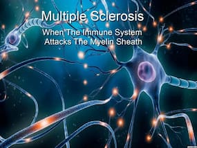 Exclusive Interview: Unmasking Multiple Sclerosis And Understanding The Invisible Battle Exclusive Interview: Unmasking Multiple Sclerosis And Understanding The Invisible Battle
