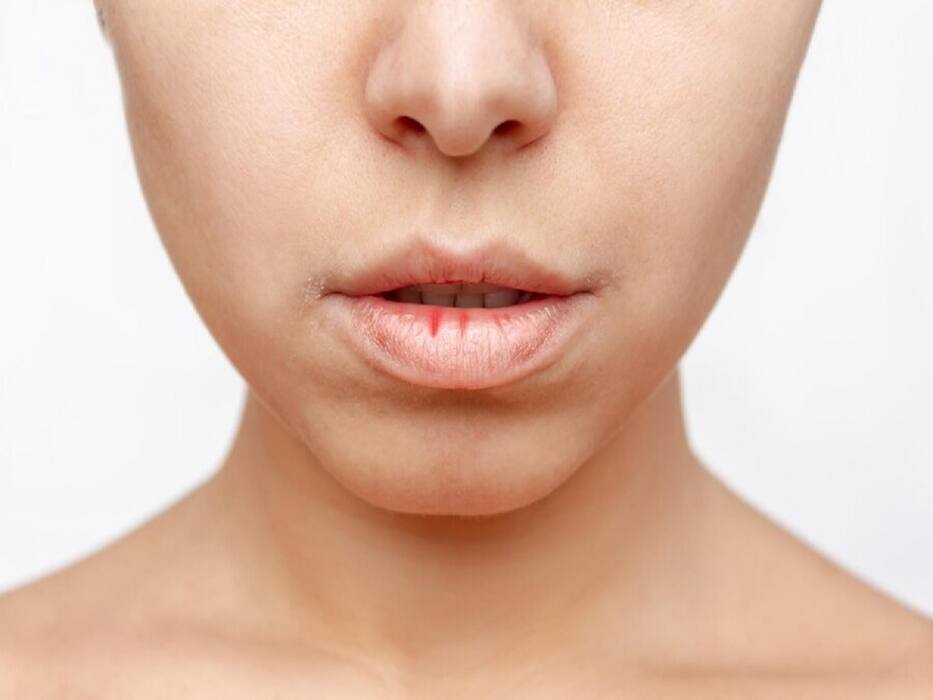 Medical Conditions That Can Cause Chapped Lips