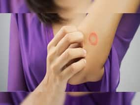 World Is Not Ready: Experts Warn After US Confirms Two New Cases of Highly Contagious Fungal Disease World Is Not Ready: Experts Warn After US Confirms Two New Cases of Highly Contagious Fungal Disease