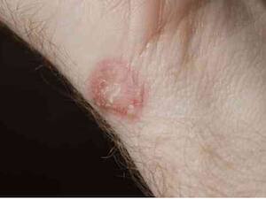Risk Factors Of Fungal Infections
