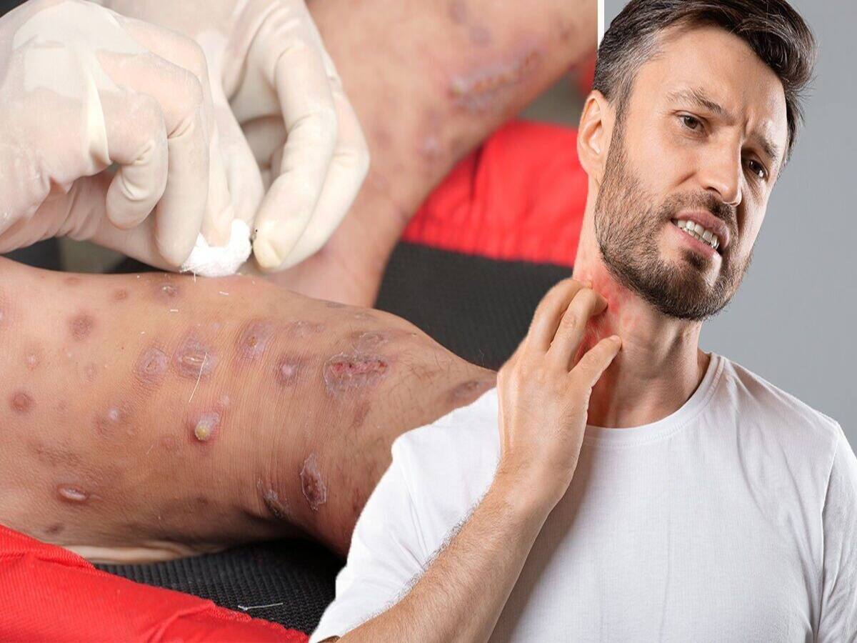 Chlamydia In Men Rash Chlamydia In Men Rash