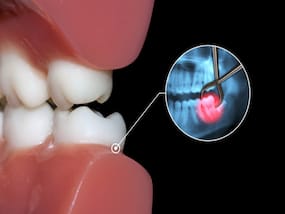 The Best And Worst Foods To Eat After Wisdom Teeth Removal