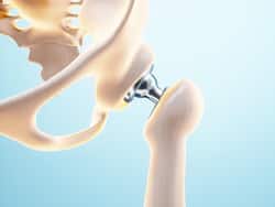 Metal Hypersensitivity After Joint Replacement Surgery Or Arthroplasty: What You Need to Know