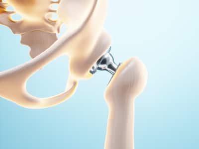 Metal Hypersensitivity After Joint Replacement Surgery: All You Need to Know