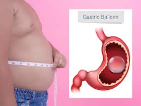 Gastric Balloon For Weight Loss: Benefits, Procedure & Side Effects Gastric Balloon For Weight Loss: Benefits, Procedure & Side Effects