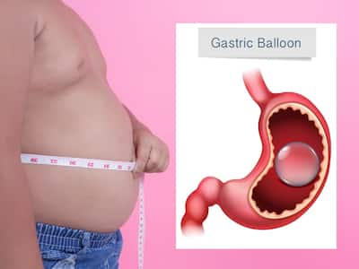 Gastric Balloon For Weight Loss: Benefits, Procedure & Side Effects