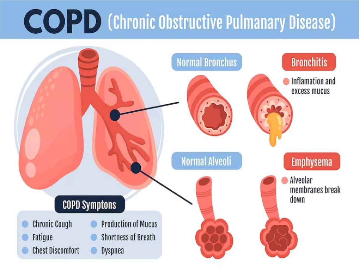 contrast-between-chronic-bronchitis-and-emphysema-medizzy