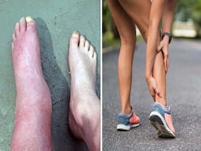 Fatty Liver Disease: Changes In Walking Style Could Be A Sign of A Troubled Liver Fatty Liver Disease: Changes In Walking Style Could Be A Sign of A Troubled Liver