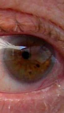 9 Glaucoma Symptoms You Should Not Avoid