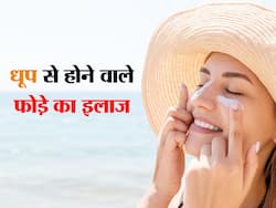 Summer Skincare Tips: गर्मियों में धूप से झुलसकर स्किन पर हो रहे हैं छाले? तो इन तरीकों से करें इलाज