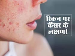 स्किन पर दिखने वाले ये लक्षण ब्लड कैंसर की हो सकती हैं निशानी, समय रहते तुरंत कराएं जांच