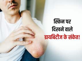 Blood Sugar बढ़ने पर स्किन में होने लगते हैं ये 5 तरह के बदलाव! जानें डायबिटीज में स्किन पर दिखने वाले संकेत