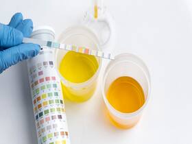 High Uric Acid Levels: 6 Vegetables That Can Help Maintain The Balance