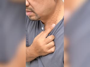 10 Warning Symptoms of Diabetes That May Appear On Your Skin