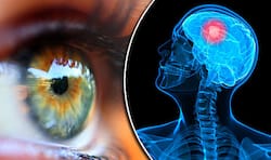Brain Tumour Symptoms: 10 Unusual Signs That May Appear on Eyes And Face