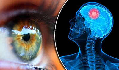 Brain Tumour Symptoms: 10 Unusual Signs That May Appear on Eyes And Face