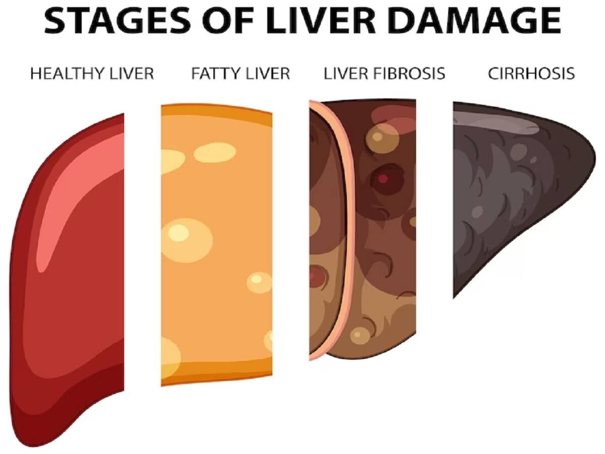 NonAlcoholic Fatty Liver Disease How India Is Empowering Medical