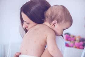Chickenpox In Motherhood: A Dermatologist   s Perspective